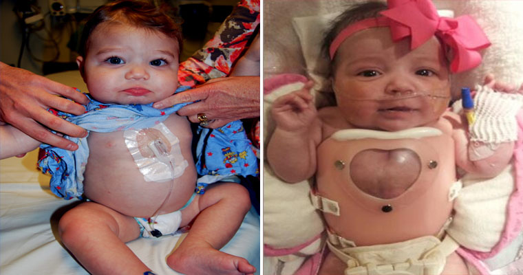 A Journey of Triumph for a Baby Born with a Heart Outside the Body !