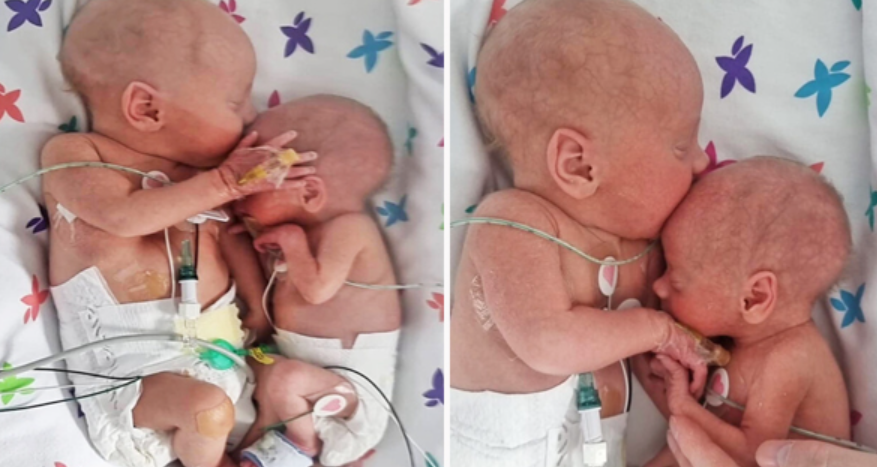 Petite Newborn Girl Hugging Her Big Brother For The First Time, Despite Physicians Warnings That She Couldn t.
