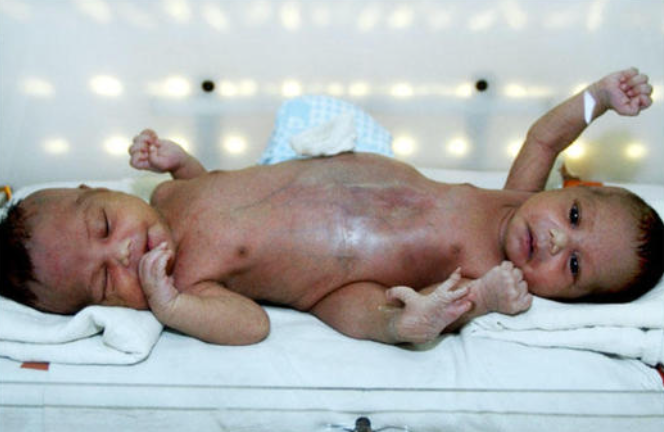 14 years ago, two of the conjoined siblings who survived the worst were photographed.