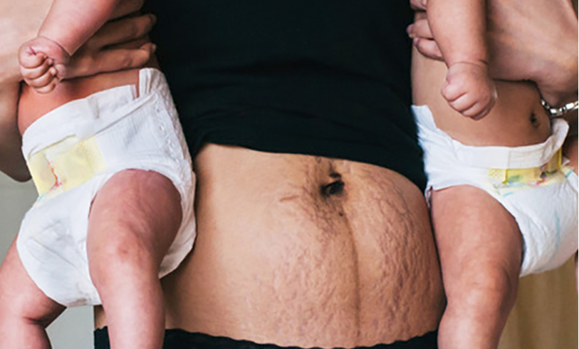 5 Inspiring Photos Of Why Moms Should Be Proud Their Postpartum Stretch Marks