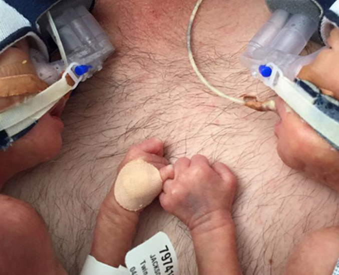 Premature Twins Holding Hands Is the Most Touching Thing